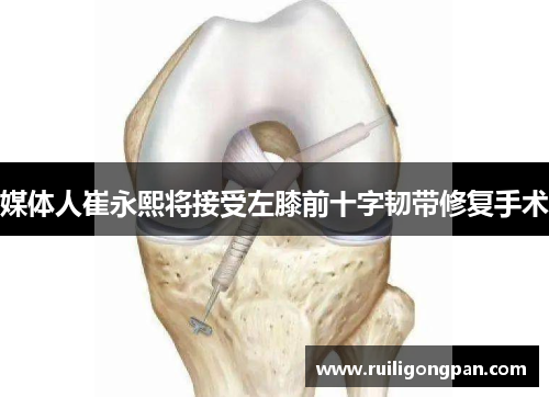 媒体人崔永熙将接受左膝前十字韧带修复手术